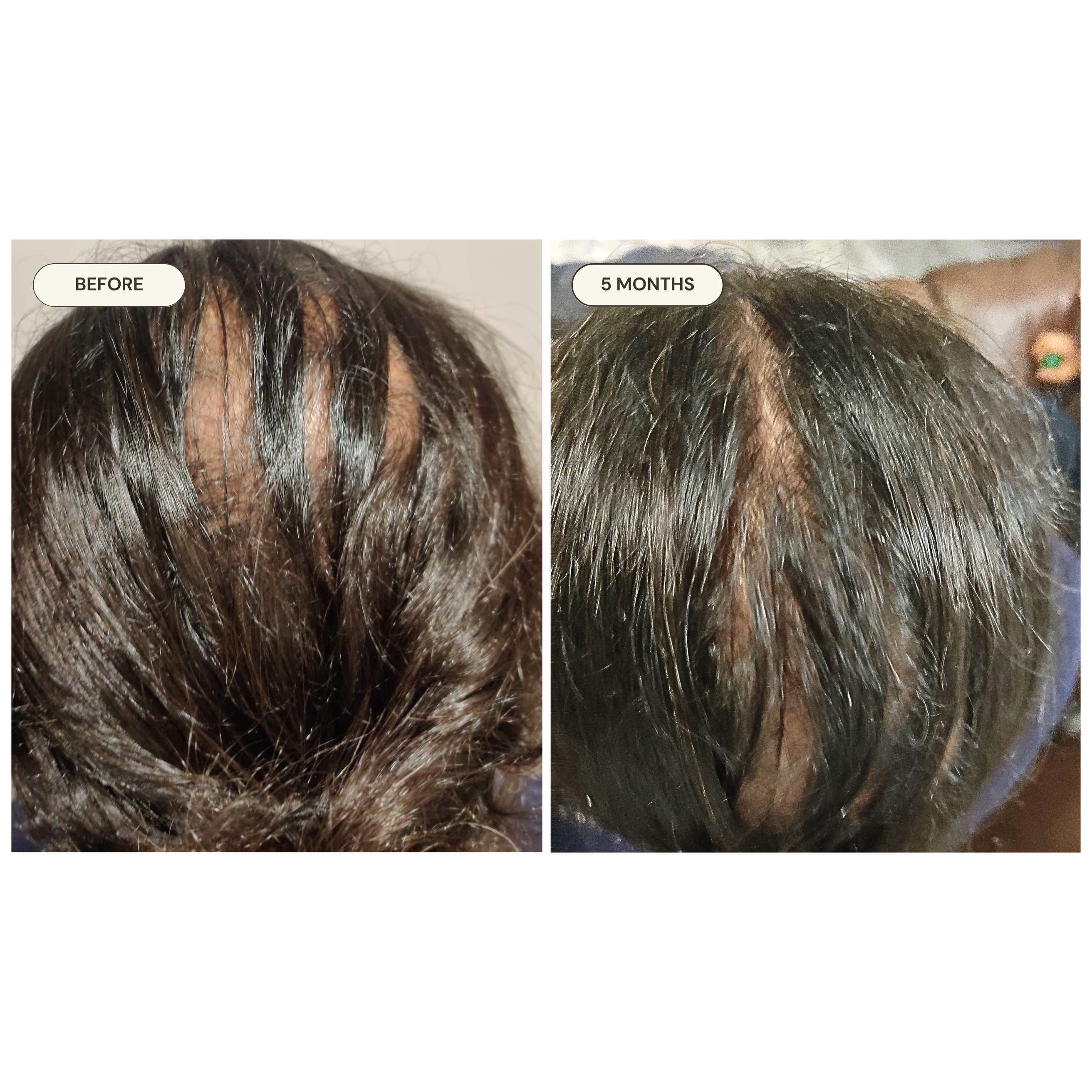 Arti before and after — Menopausal Hair Loss