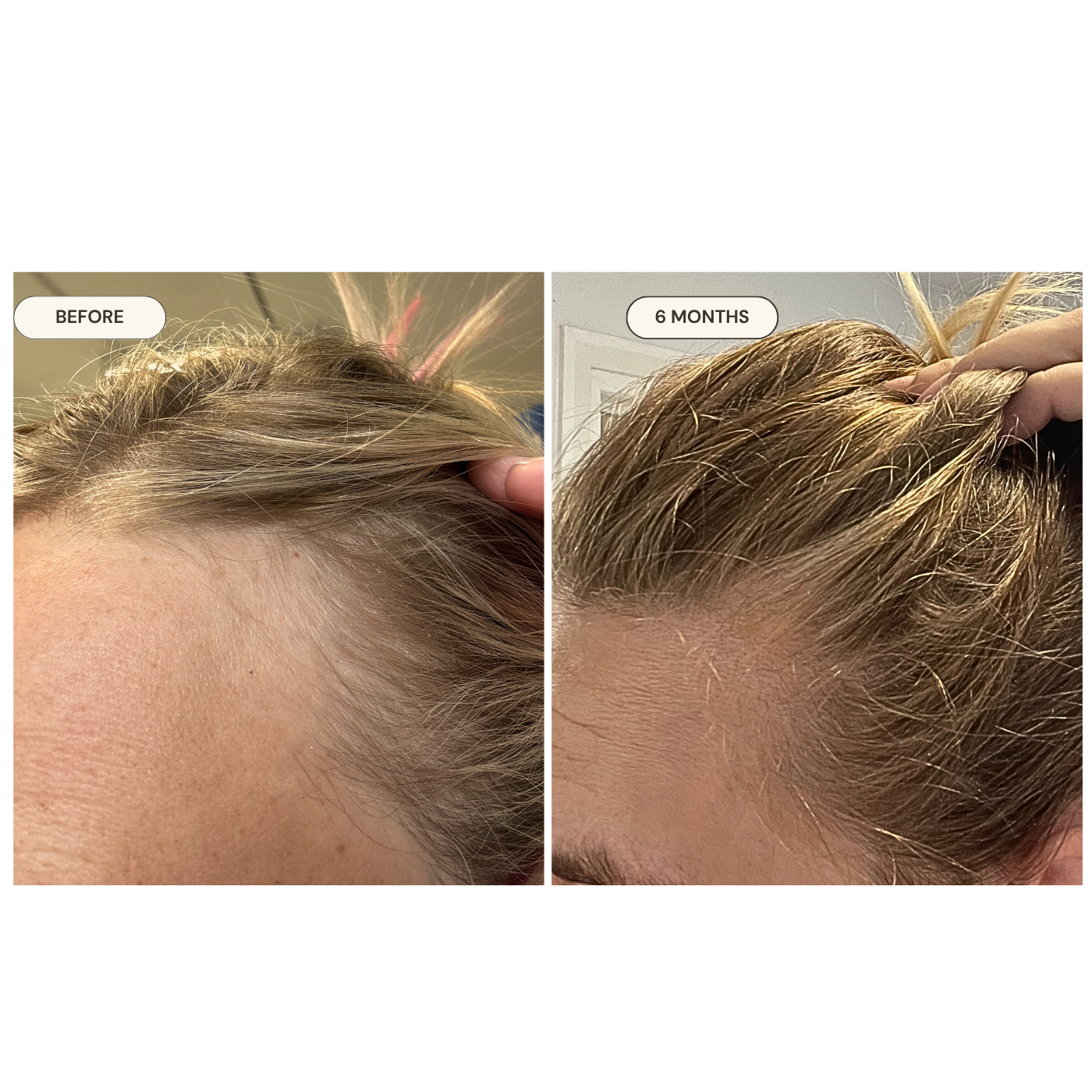 DEE before and after — Post-partum Hair Loss
