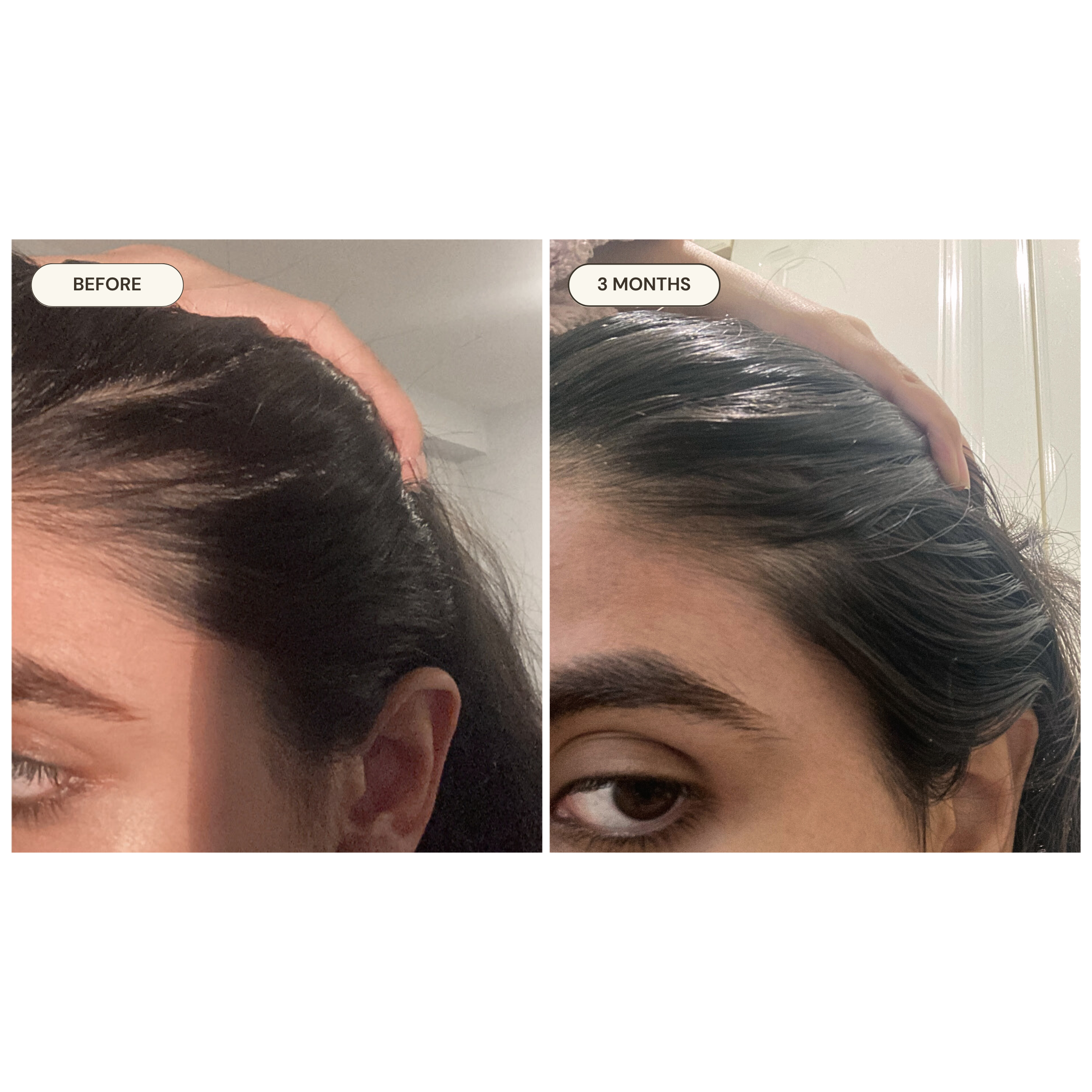 Maneeha before and after — Stress-Related Hair Loss