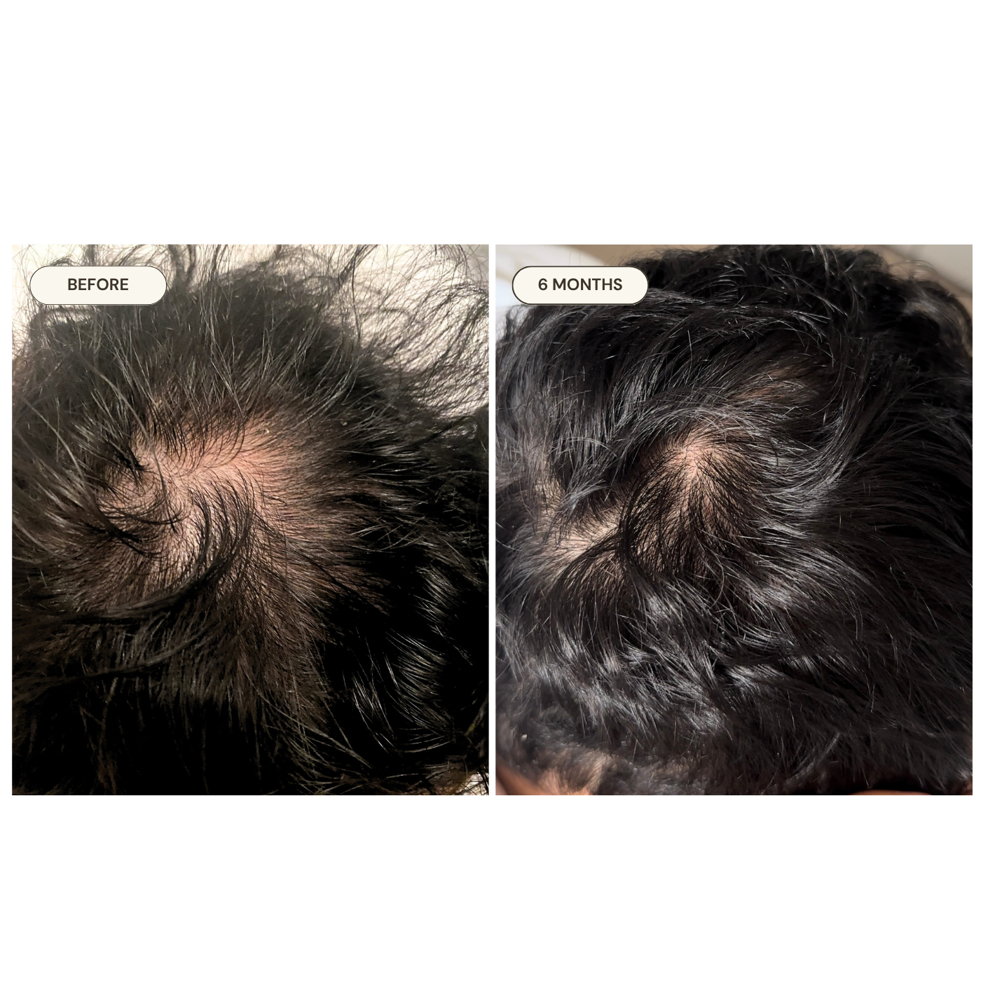 Moe before and after — Androgenic alopecia