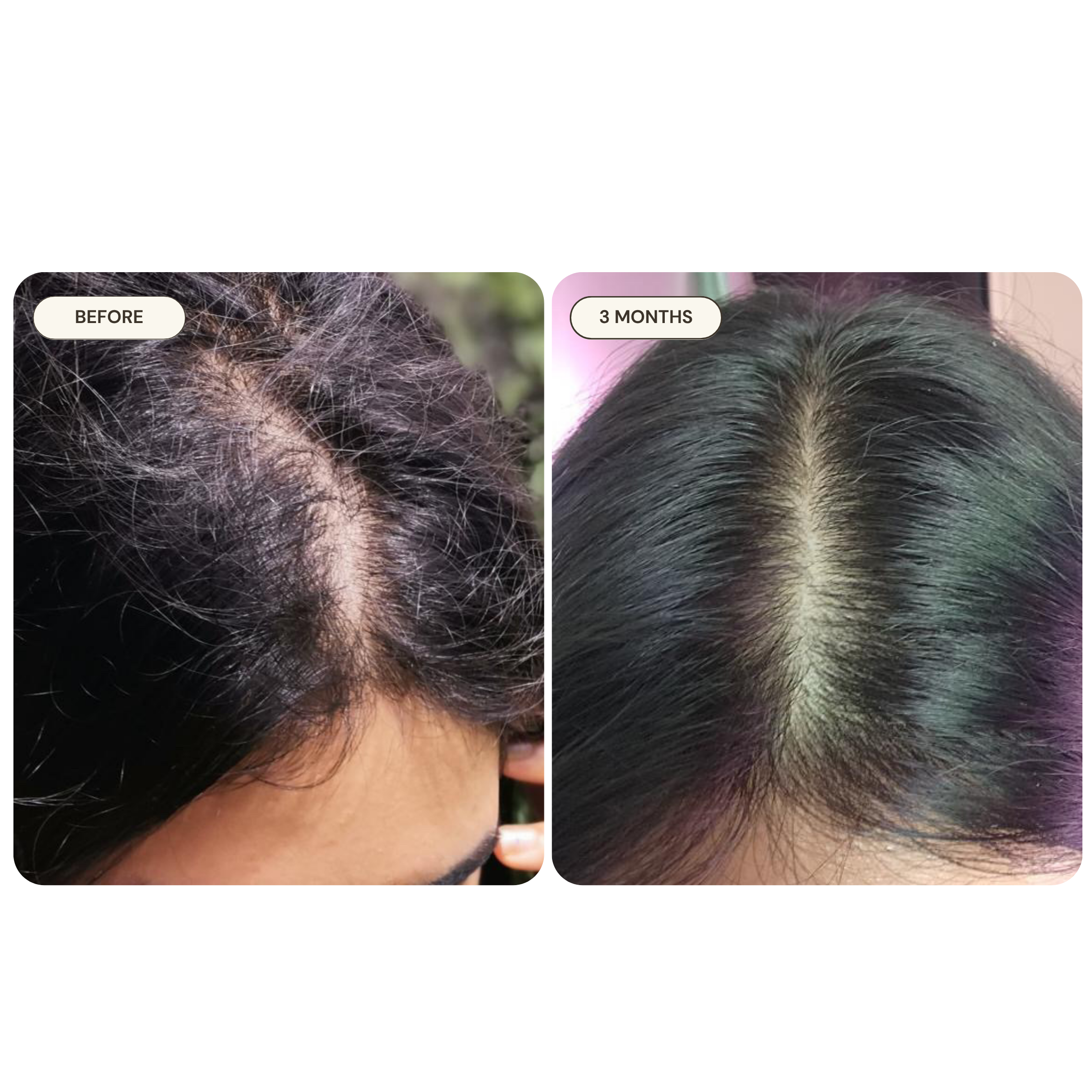 Priyanka before and after — PCOS-Induced Hair Loss