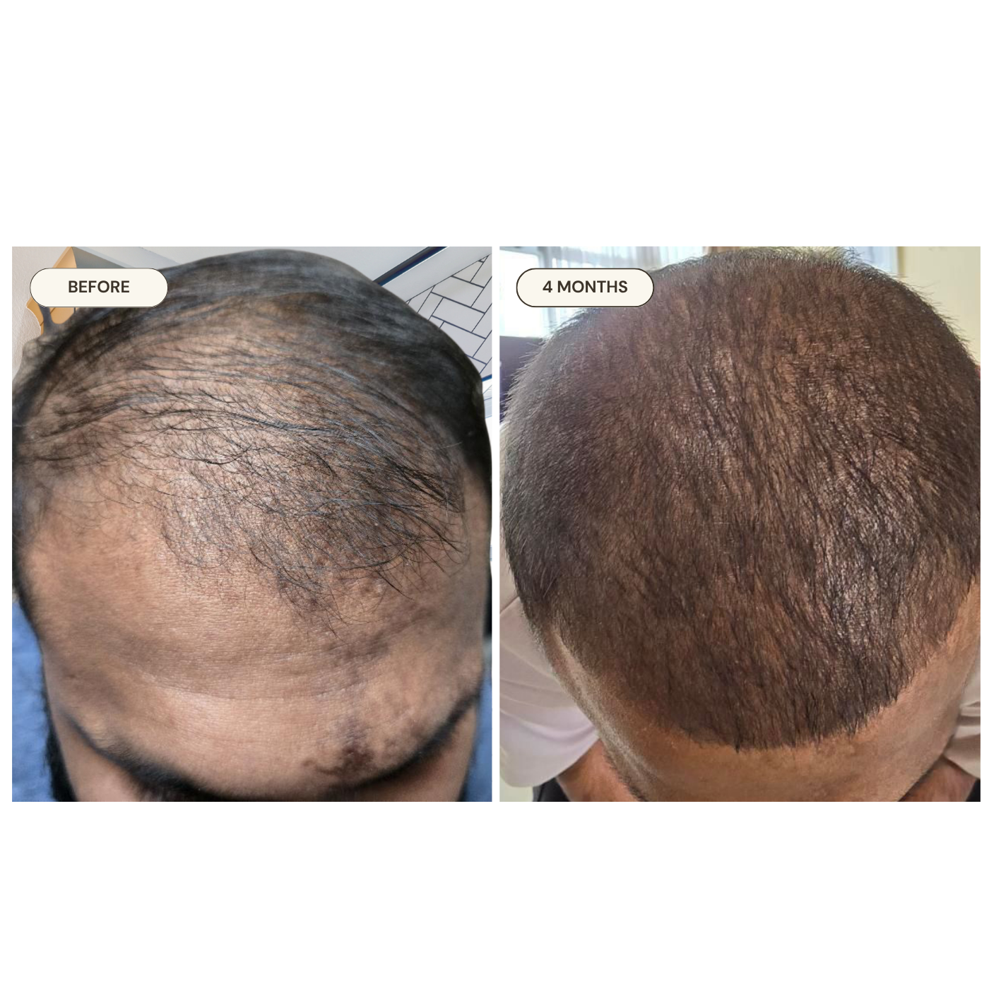 Rishi before and after — Post-Chemotherapy